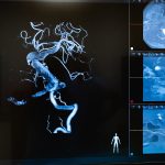 Budějovická intervenční radiologie jako první v České republice zavedla do gigantické mozkové výdutě u mozkového kmene speciální stent