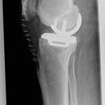 Unikátní operace v Prachaticích: Ortopedi nahradili pacientovi obě kolena šetrnou metodou