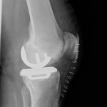 Unikátní operace v Prachaticích: Ortopedi nahradili pacientovi obě kolena šetrnou metodou