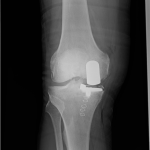 Unikátní operace v Prachaticích: Ortopedi nahradili pacientovi obě kolena šetrnou metodou