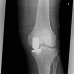 Unikátní operace v Prachaticích: Ortopedi nahradili pacientovi obě kolena šetrnou metodou